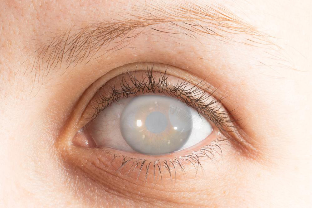 Five facts to know about cataract and its surgery