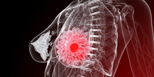 Five things you need to know about breast cancer