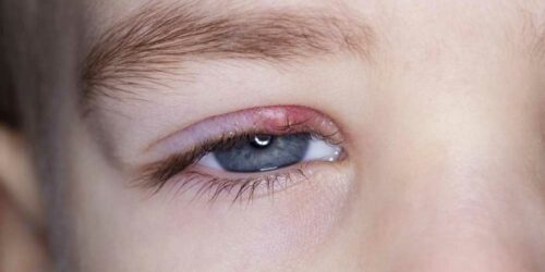 Know about the Symptoms and Causes of Eyelid Inflammation