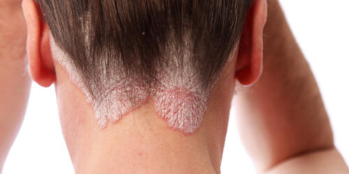 Know the skin ailment: Scalp psoriasis