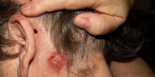 How can you spot the signs of staph infection