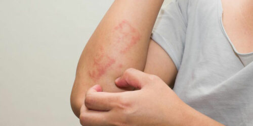 How to identify and treat poison ivy rash with daily use products