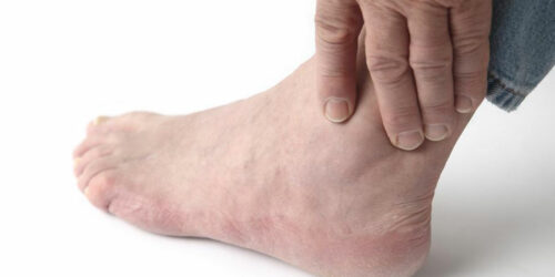 Home treatment for relief from gout foot pain