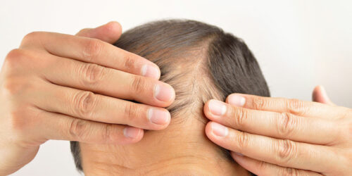 Hair loss – Its symptoms and causes