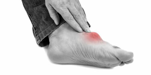 Immediate pain relief measures for gout