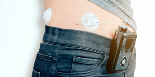 Insulin pumps &#8211; 3 best devices to buy in 2021