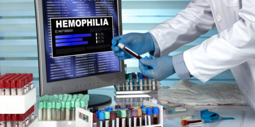 Overview: Hemophilia A and Hemophilia B