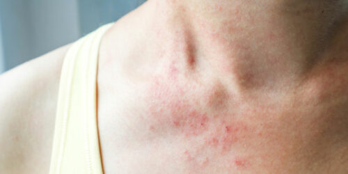 Mycosis fungoides &#8211; more than just a skin rash