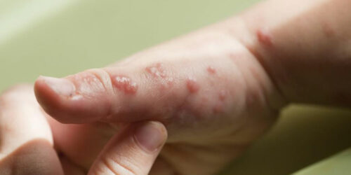 Nerves could be at risk due to shingles