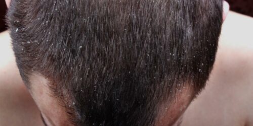 Scalp Psoriasis