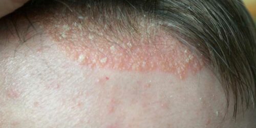 Scalp Psoriasis &#8211; Symptoms to Watch out For