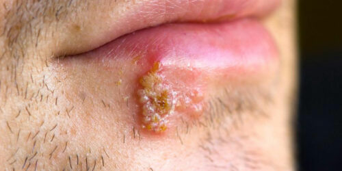 Signs that tell you might have herpes