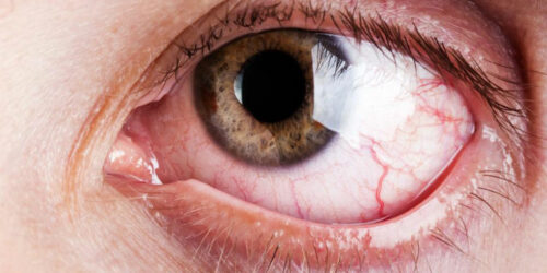 Signs that you might be experiencing dryness of your eyes