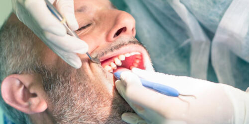 Simple yet effective ways to prevent and remove dental plaque