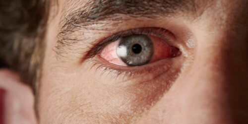 Sjogren&#8217;s Syndrome- Causes and Symptoms