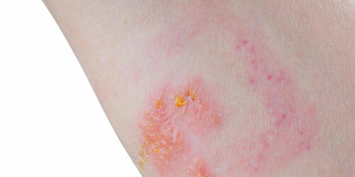 Skin Rash: Which condition is it?