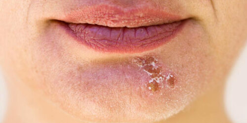 Popular essential oils to bid goodbye to cold sores