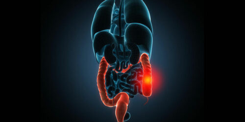 Popular treatments for irritable bowel syndrome