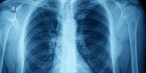 Pathology and Pathophysiology of Asthma