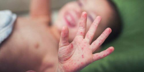 Prevention Tips for Hand, Foot, and Mouth Disease