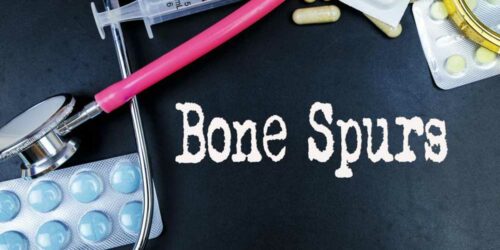 Prevention and Treatment for Bone Spurs