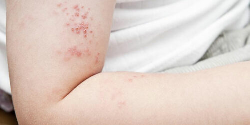 Prevent yourself from shingles before it infects you