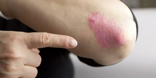 Psoriasis Symptoms