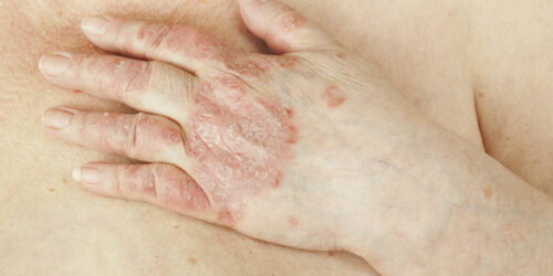 Psoriatic arthritis and popular treatment options