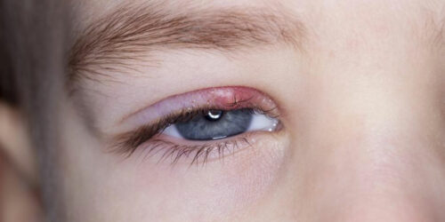 Remedies to get rid of stye