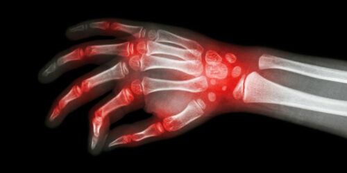 Rheumatoid arthritis and lupus – what makes them similar?