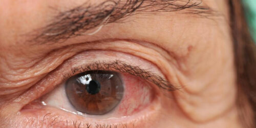 Ways of dealing with chronic dry eye disease