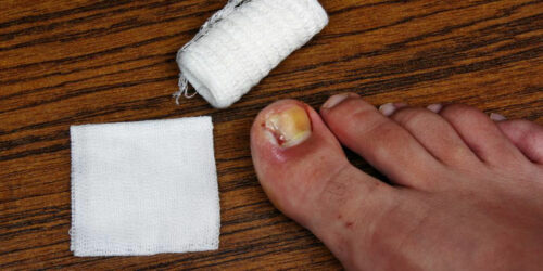 Ways to Treat Toe Nail Fungus During Pregnancy