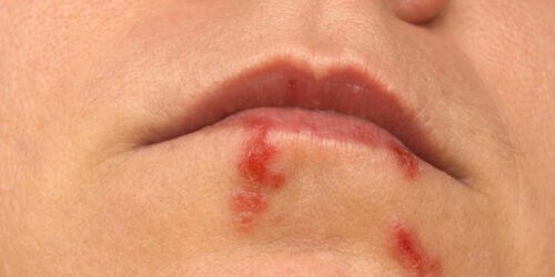 Ways to stop herpes from spreading