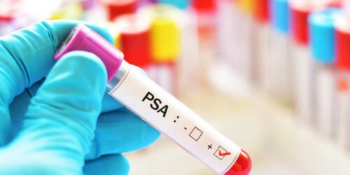 What are the Normal PSA Levels as Per Age