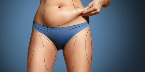 What is coolsculpting fat freezing?