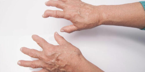 What you need to know about Rheumatoid Arthritis and Lupus