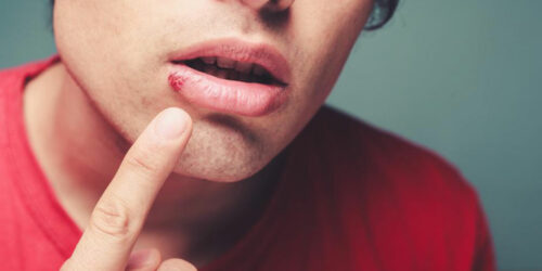 Top 4 FAQs about cold sores