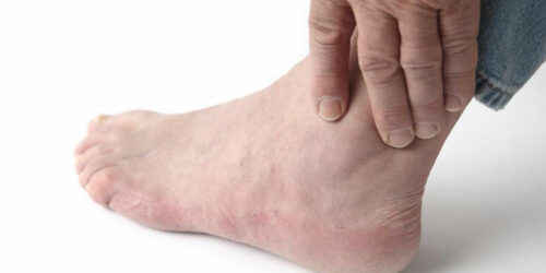 Top Causes of Swollen Ankles