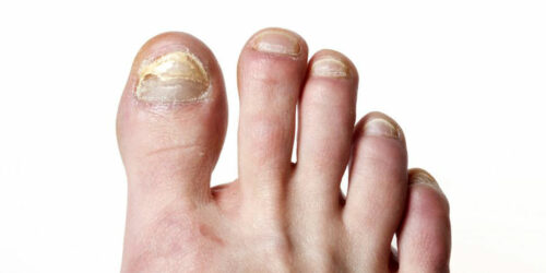 Top signs of toe nail fungus