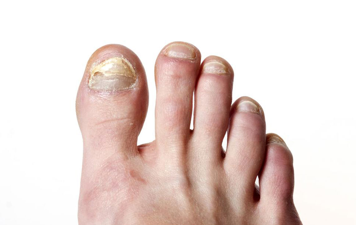 Top signs of toe nail fungus