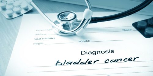 The Common Causes of Bladder Cancer