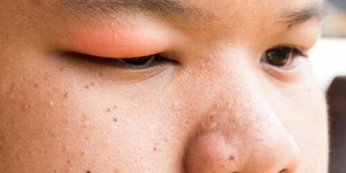 These are the causes of stye that you need to be aware of