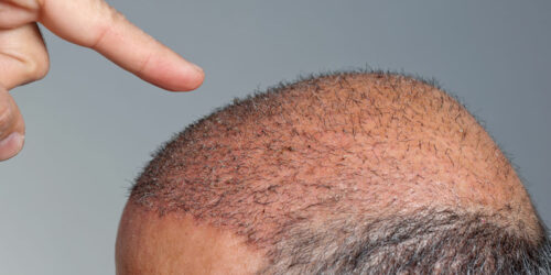 The truth about how much hair transplants cost