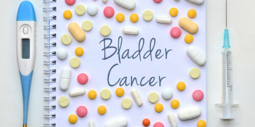 Things to know about the different stages of bladder cancer