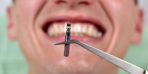 Things you should know about dental implants costs