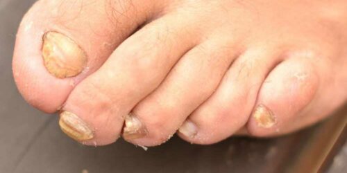 Tips to Treat Nail Fungus Effectively