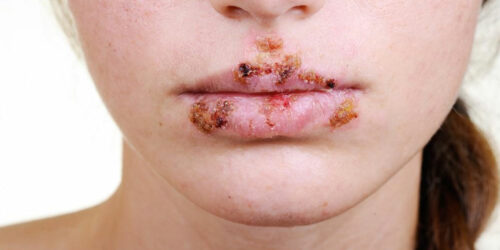 Tips to manage herpes outbreak