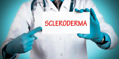 Treating the early symptoms of scleroderma