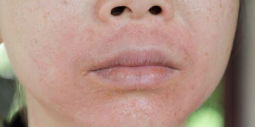 Treatment Methods for Lupus Skin Rashes