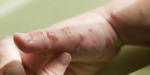 Treatment for symptoms of viral infections